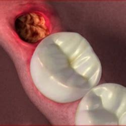 Dry Socket After Wisdom Teeth Removal | New Health Advisor