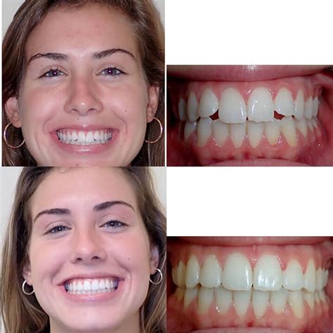 Before & After Invisalign | Wazio Orthodontics