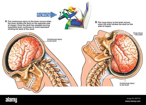 Traumatic Brain Injury - Closed Head Injury - Coup and Contrecoup Stock Photo: 7710392 - Alamy