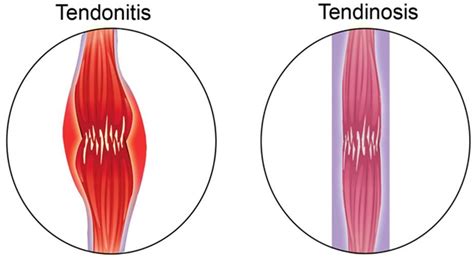 Tendonitis vs Tendinosis - Advanced Physical Therapy