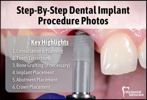 Step-By-Step Dental Implant Procedure Photos | MDA