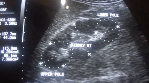 ULTRASOUND PYELONEPHRITIS acute part 1 - YouTube