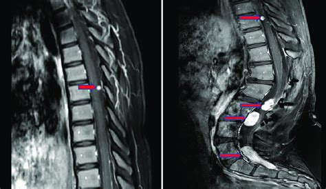 Preoperative MRI with gadolinium contrast demonstrating five ...