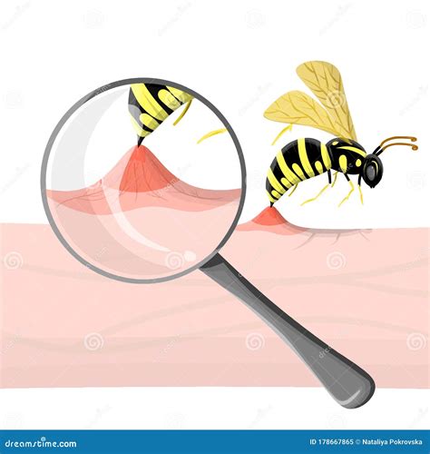 Wasp Sting Human. Close Up Detailed with Magnifier Pathogenesis of Bee ...