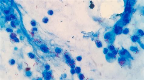 Ziehl-Neelsen Stain-Ziehl-Neelsen Staining Method - Microbiology