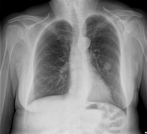 Hamartoma chest x ray - wikidoc