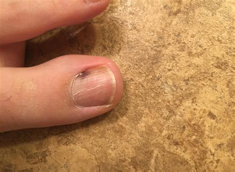 Melanoma under toenail pictures: black spot, nail melanoma pictures, toenail melanoma pictures ...