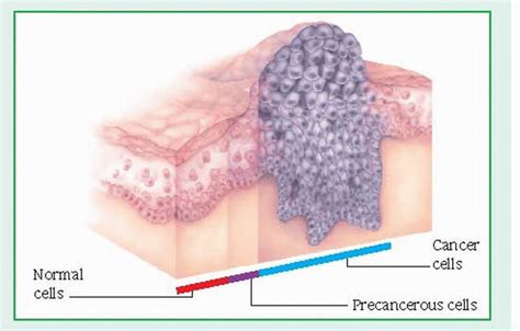 Malignant Neoplasms | Basicmedical Key