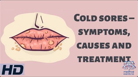 Cold Sores Causes Symptoms Risk Factors Diagnosis Treatment, 41% OFF