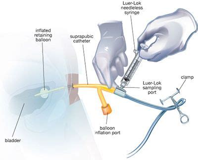 Urinary Catheter Care | Urinary catheterization, Catheter, Medical knowledge