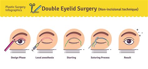 Double Eyelid Surgery in Korea - Seoul Guide Medical