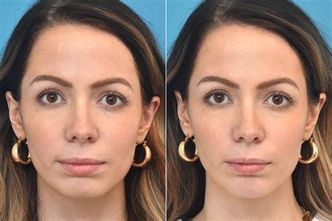 Injectable Fillers photos | Philadelphia, PA | Patient 1368