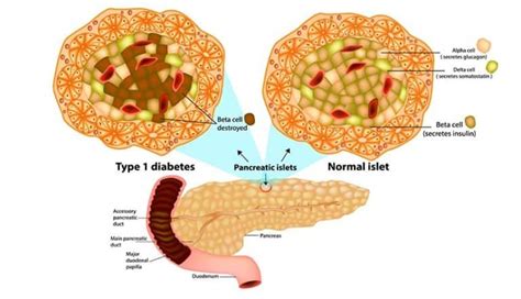 Can You Regenerate Beta Cells Naturally for Type 1 Diabetes?