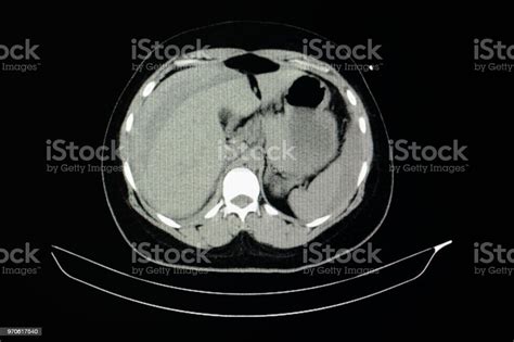 Ct Scan Of Liver Laceration Stock Photo - Download Image Now - Accidents and Disasters, Anatomy ...