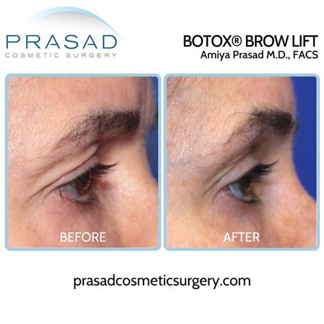 Can Plastic Surgery Fix Hooded Eyes? | Prasad Cosmetic Surgery