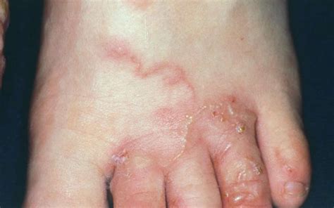 Cutaneous larva migrans causes, symptoms, diagnosis, treatment & prognosis