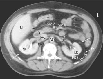 The Normal Kidney | Radiology Key