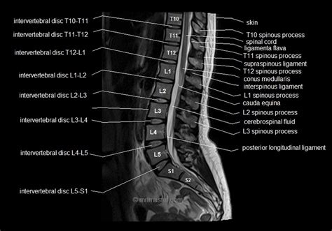 Lumbar Spine Mri Labeled