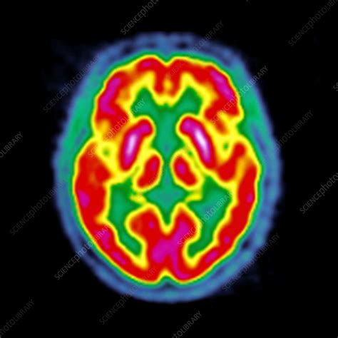 Normal brain activity, PET scan - Stock Image - C026/7610 - Science Photo Library