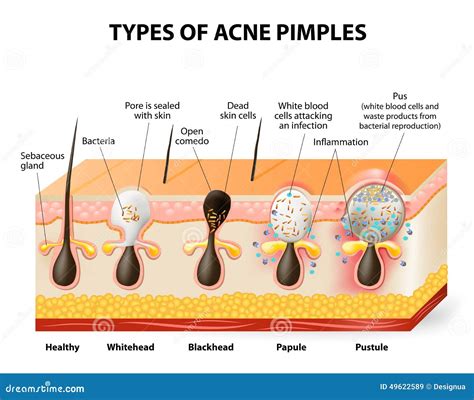 Acne Types Pimple Skin Diseases Anatomy Medical Diagram Vector | Images ...