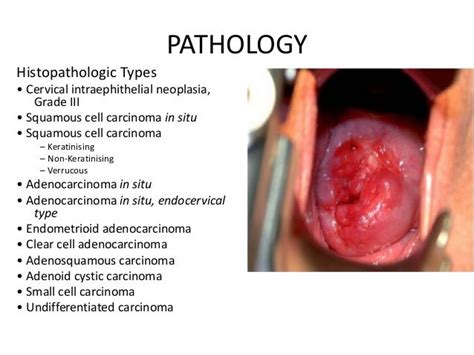 Cervical cancer