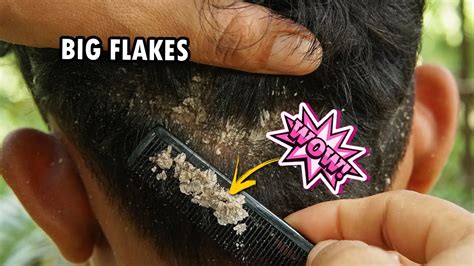 Dry Scalp Flakes