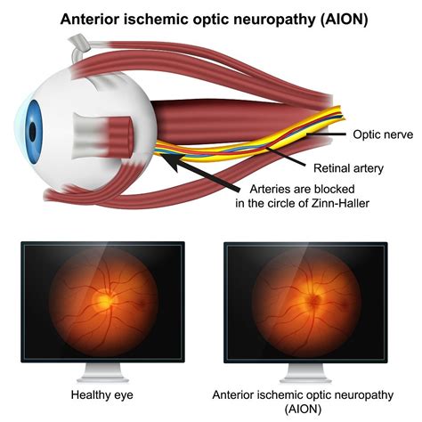 Optic Nerve