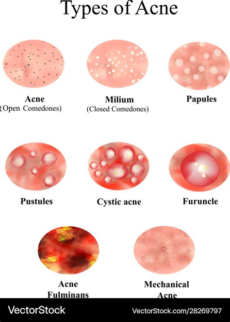 Types acne skin inflammation pimples boils Vector Image