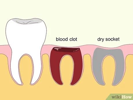 Dry Socket Treatment