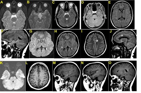 MRI of brain. (A) T2 fat sat image right optic nerve hyperintensity... | Download Scientific Diagram