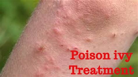 Poison Ivy Rash On Skin