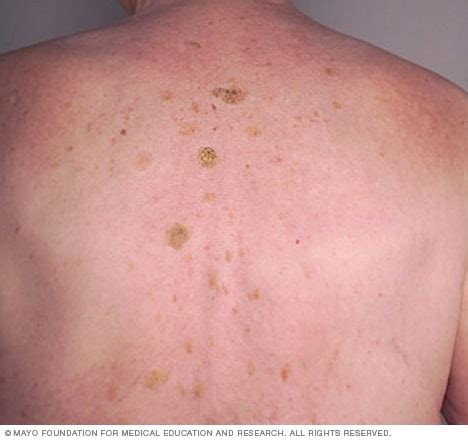 Seborrheic keratoses on the back - Mayo Clinic