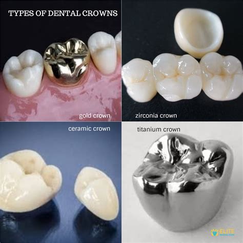 TYPES OF DENTAL CROWNS FOR DIFFERENT PATIENTS - ELITE DENTAL CARE TRACY ...