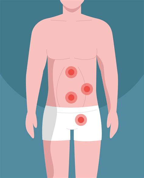 Hernia - SynappseHealth