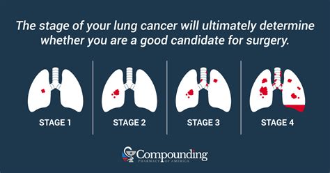 Learning That Your Lung Cancer Is “Inoperable” - Syndication Cloud