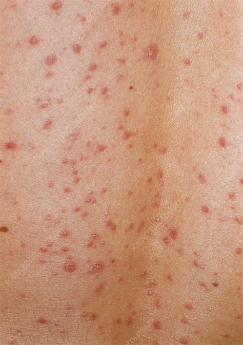 Guttate psoriasis skin rash - Stock Image - M240/0356 - Science Photo Library