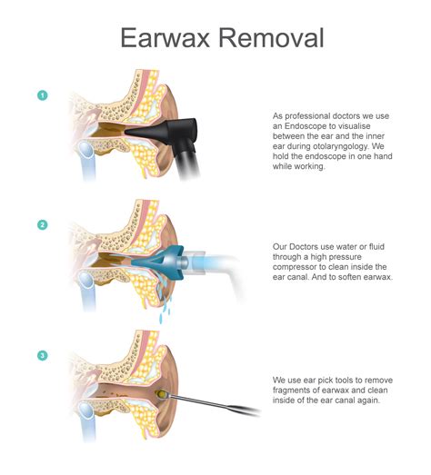 Ear Wax Removal London | Ear Microsuction | London Hearing