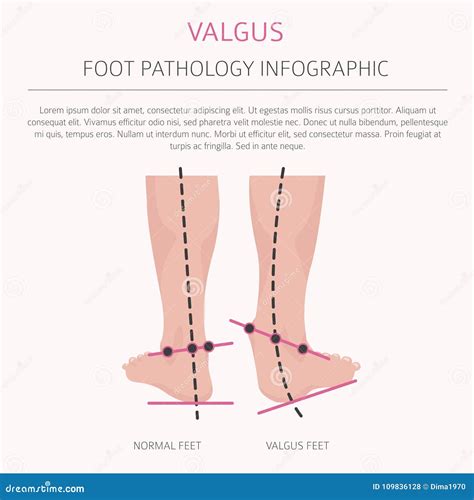 Valgus Vs Varus Of Ankle