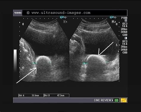 A Gallery of High-Resolution, Ultrasound, Color Doppler & 3D Images - Urinary bladder