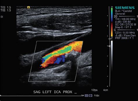 Pathophysiology Stenosis Carotid Artery Vascular Ultrasound | The Best Porn Website