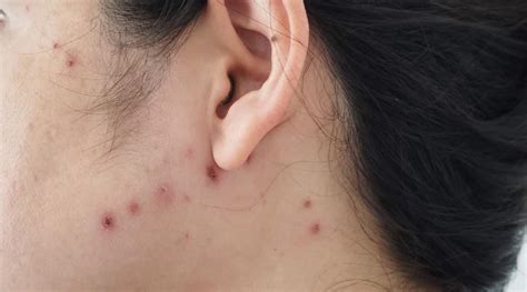 Outrageous Tips About How To Avoid Chicken Pox Scars - Treecurve