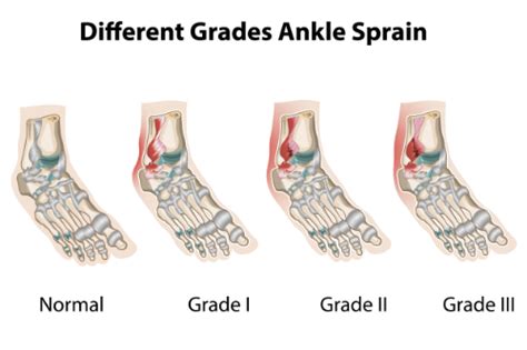 The 3 Grades of An Ankle Sprain & How Chiropractic Can Help ...