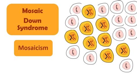 Mosaicism Down Syndrome