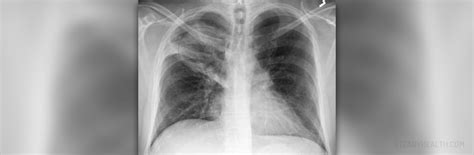 Dust pneumonia facts | General center | SteadyHealth.com