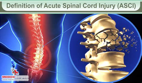 Acute Spinal Cord Injury Treatment: A Bridge to Recovery