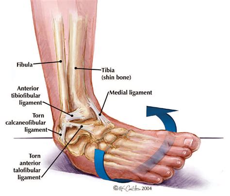 Do you ice your ankle after an ankle sprain? There's more to it!