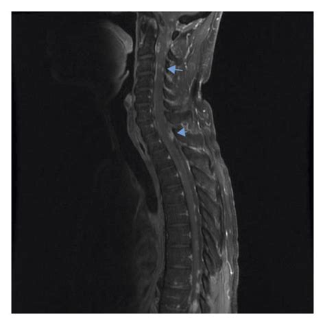 MRI spinal cord, sagittal, T2-weighted showing hypointense nodules... | Download Scientific Diagram