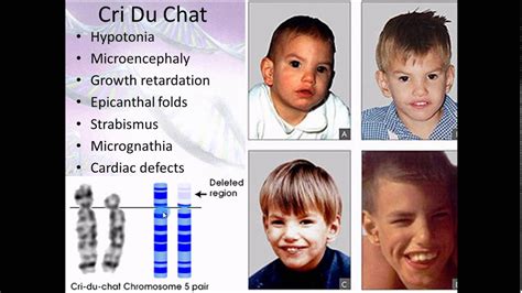 Pathophysiology 16 Chromosomal abnormalities - YouTube