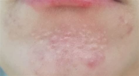 Any help identifying what these bumps plaguing my chin are? – General acne discussion – Acne.org ...