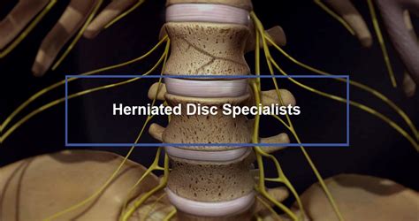 Herniated Disc S1 - S2 Symptoms & Treatment - Dr. Kevin Pauza, The Discseel® Procedure inventor